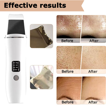 Ultrasonic Skin Scrubber Facial Deep Cleansing Blackhead Remove Ultrasonic Cleansing Cavitation Peeling Shovel Skin Scrubber